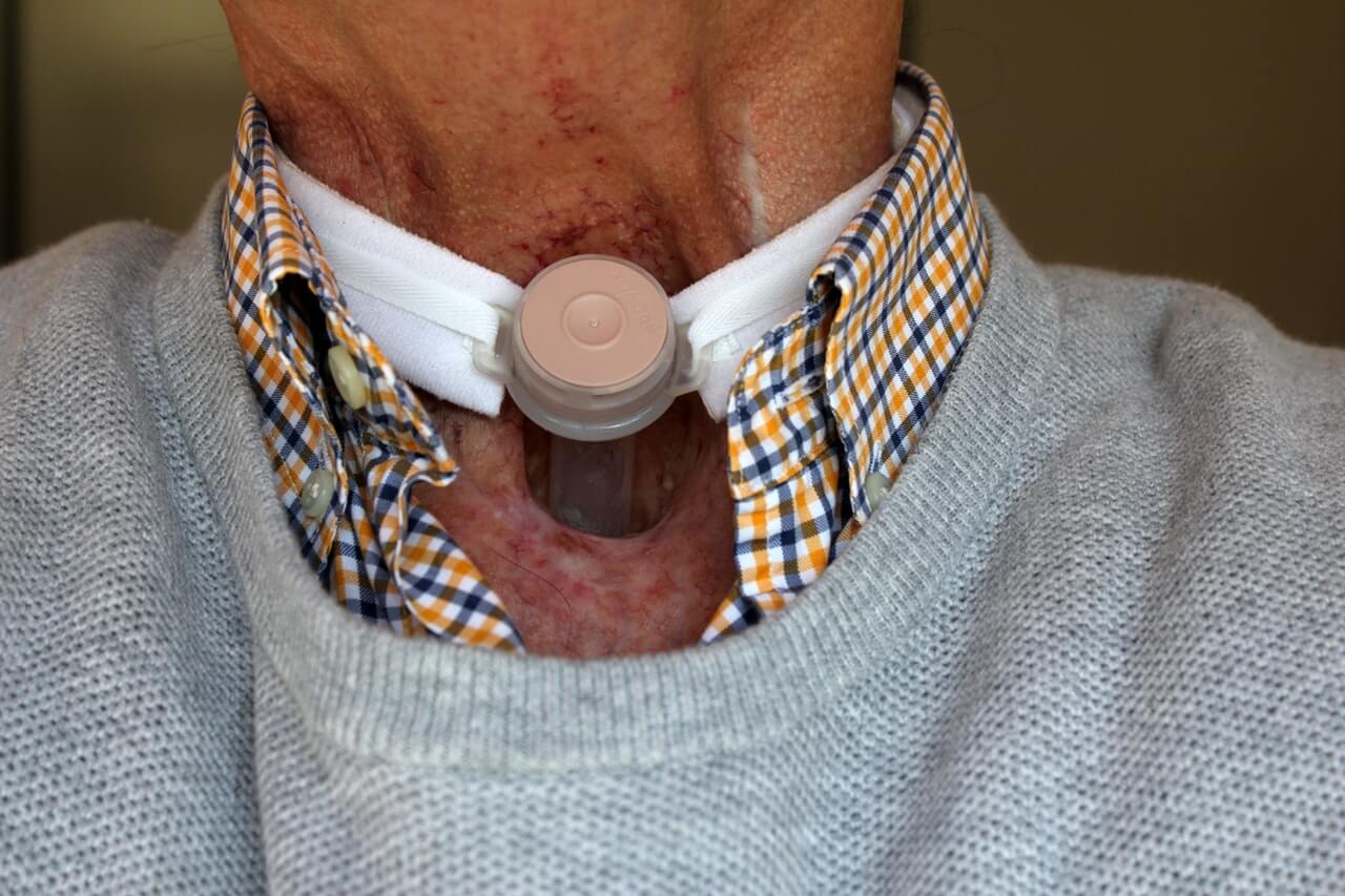 tracheostomy