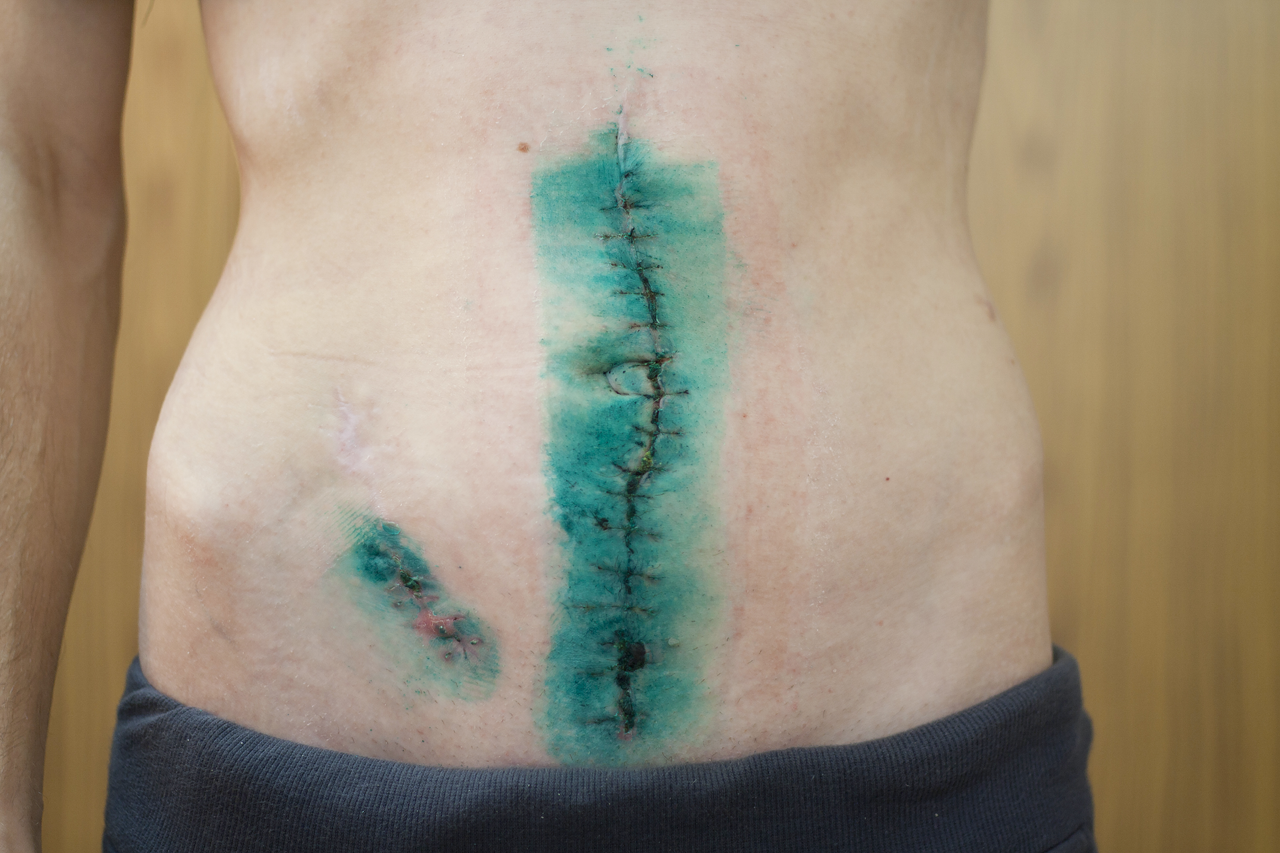 Ulcerative Colitis Surgery