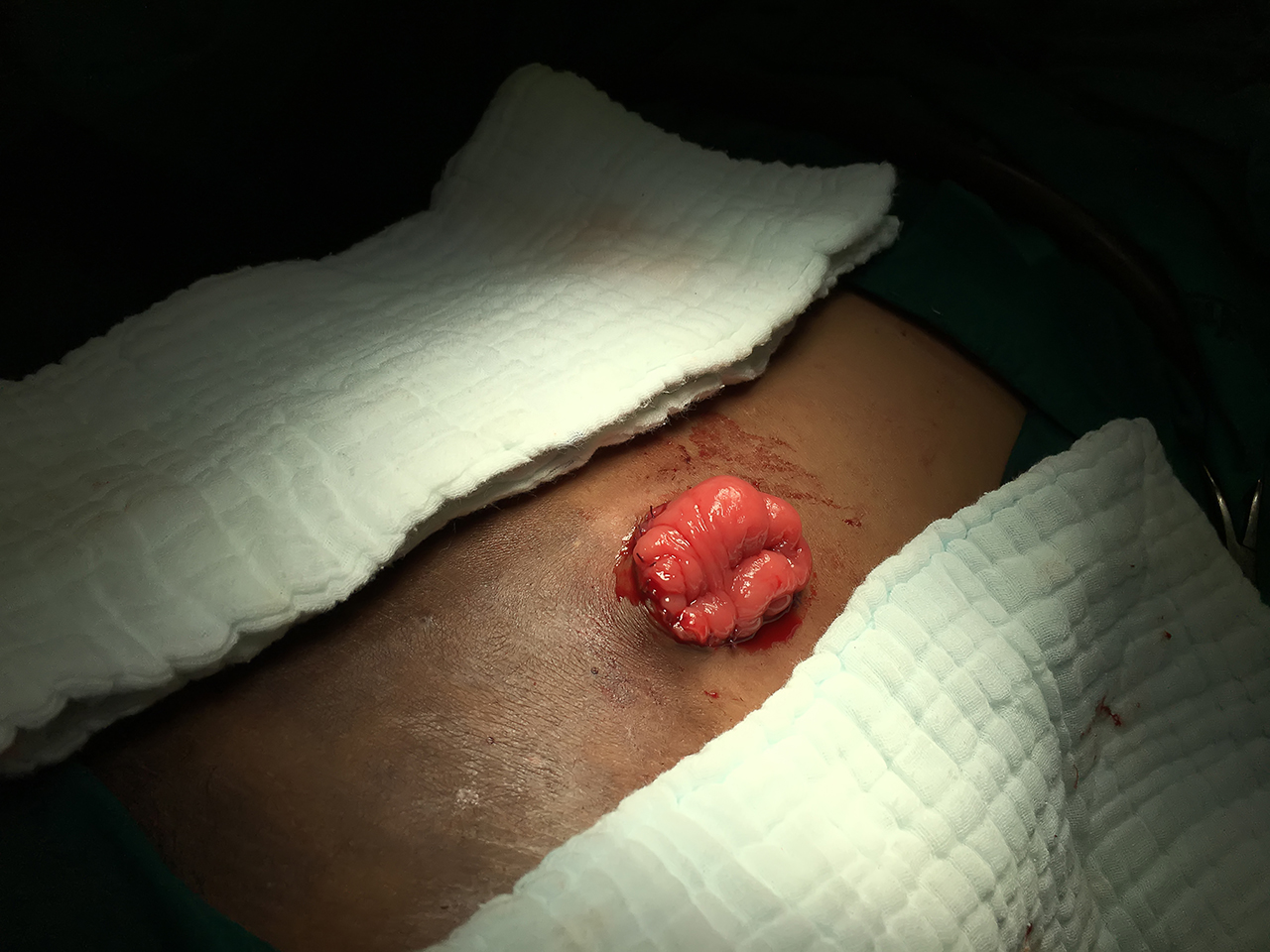 ostomy surgery