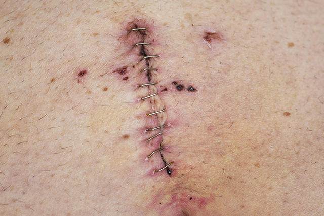 ostomy