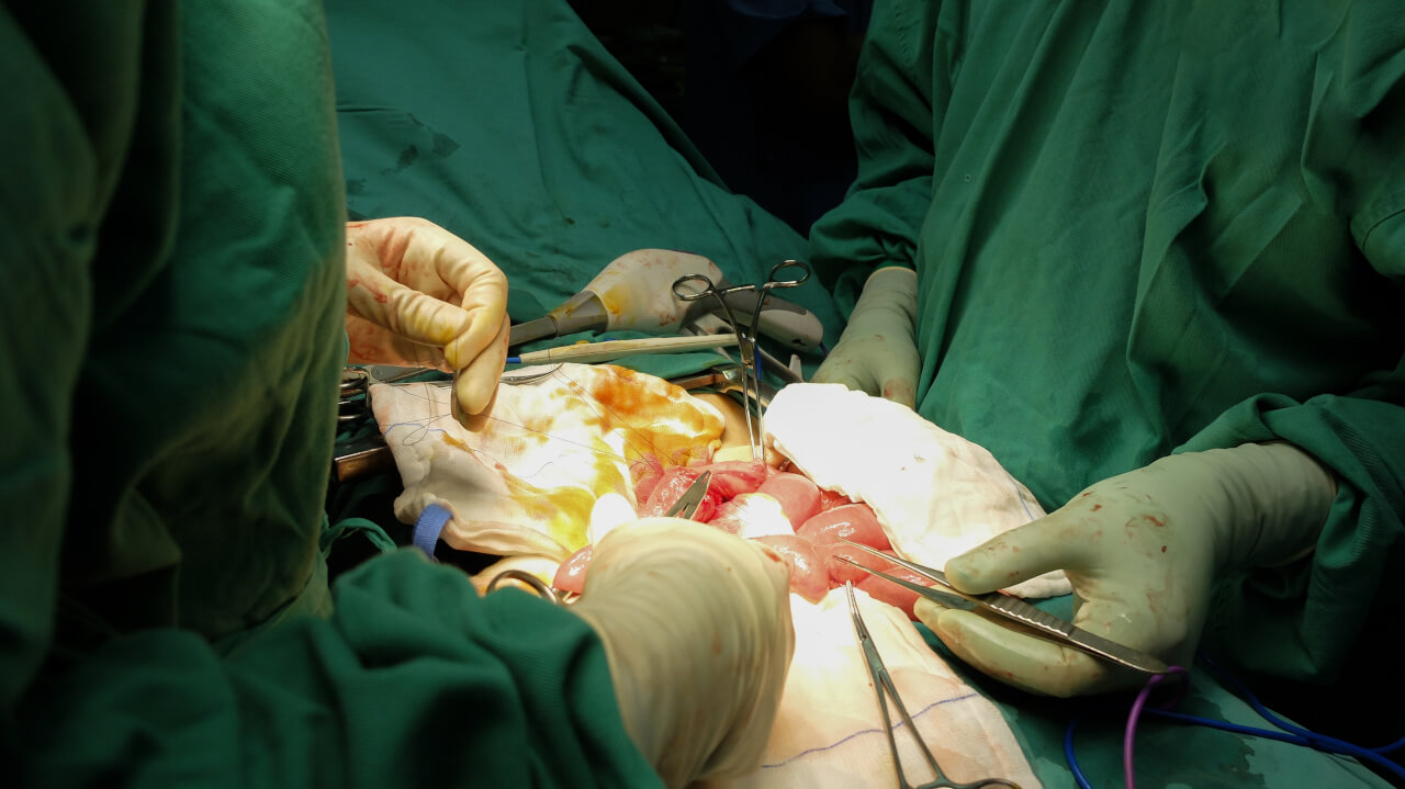 Small Intestine Surgery