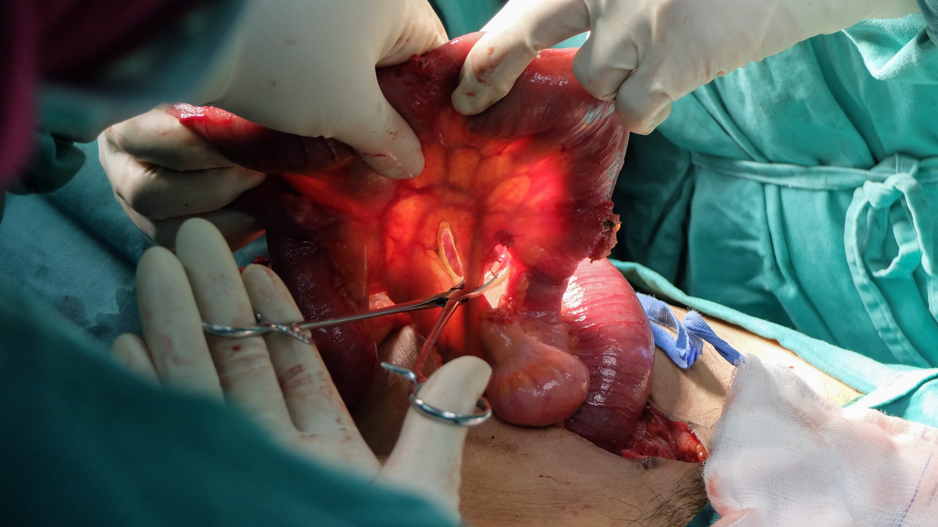 Small Intestine Surgery