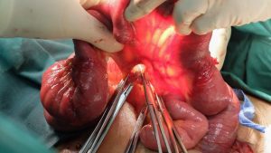 Small Bowel Resection