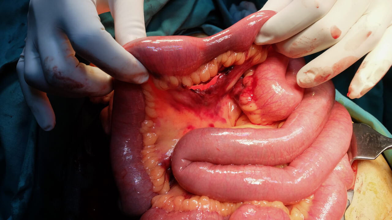 Small Bowel Resection