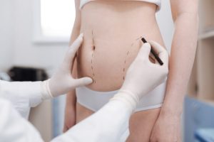 stomach fat removal surgery