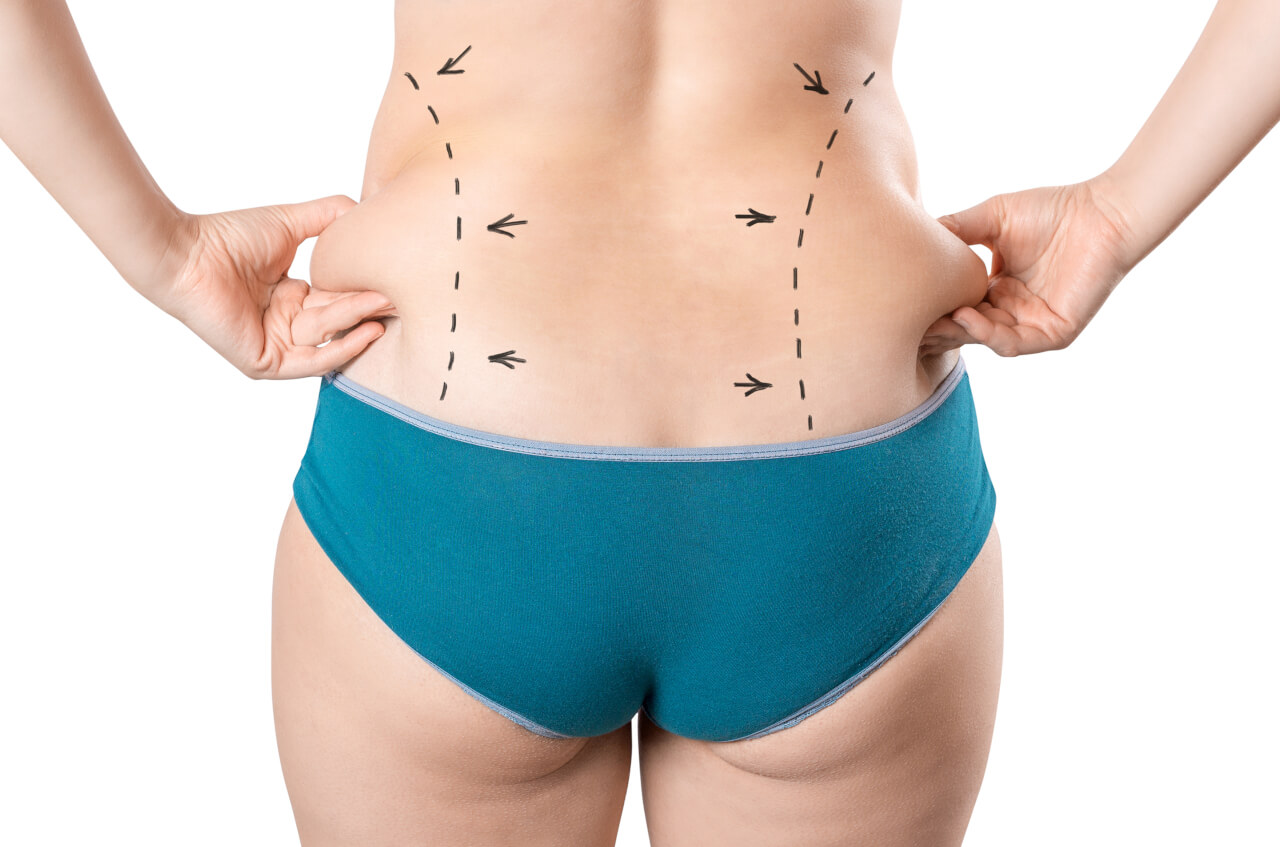 stomach fat removal surgery