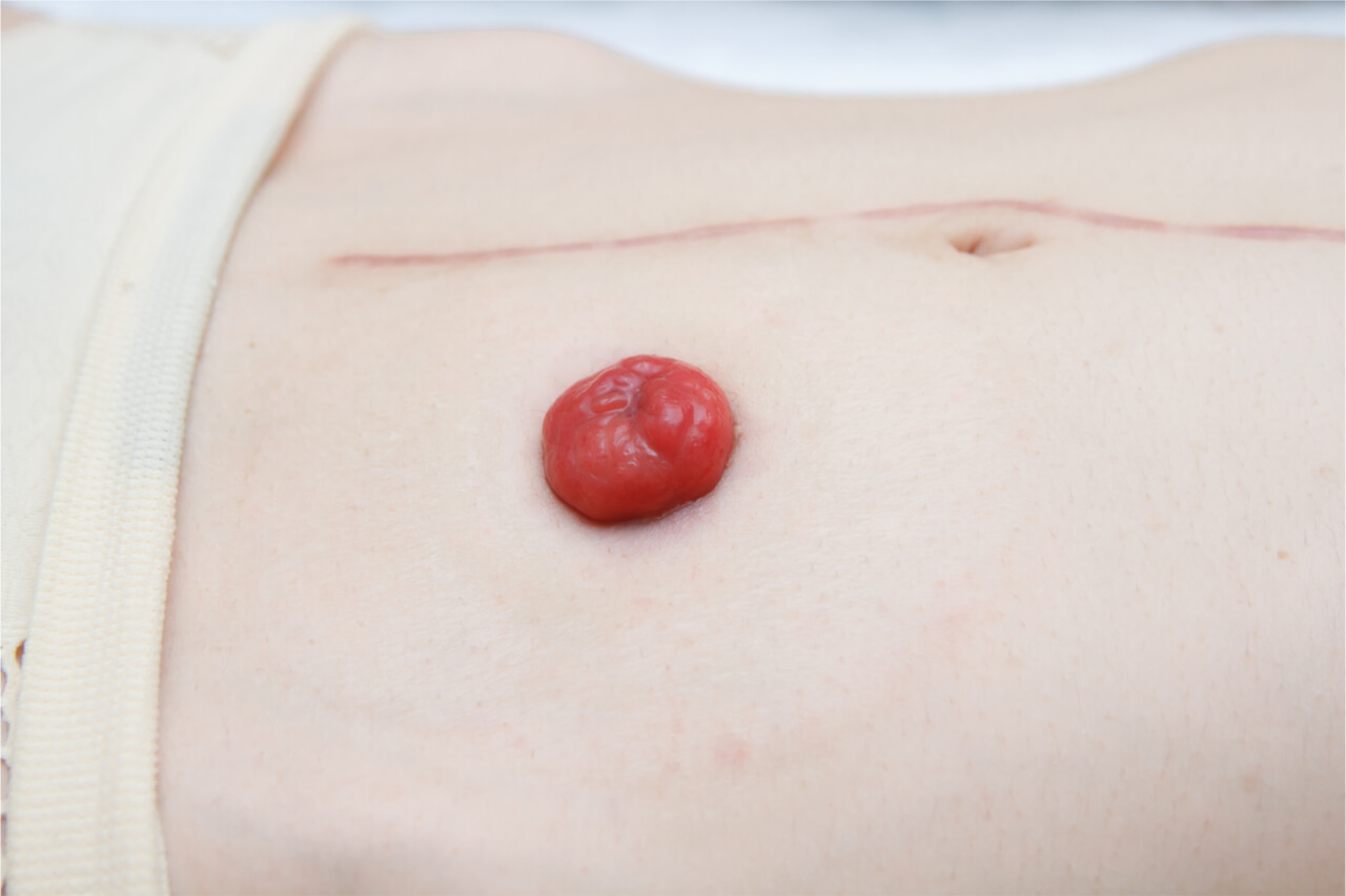 ostomy vs otomy