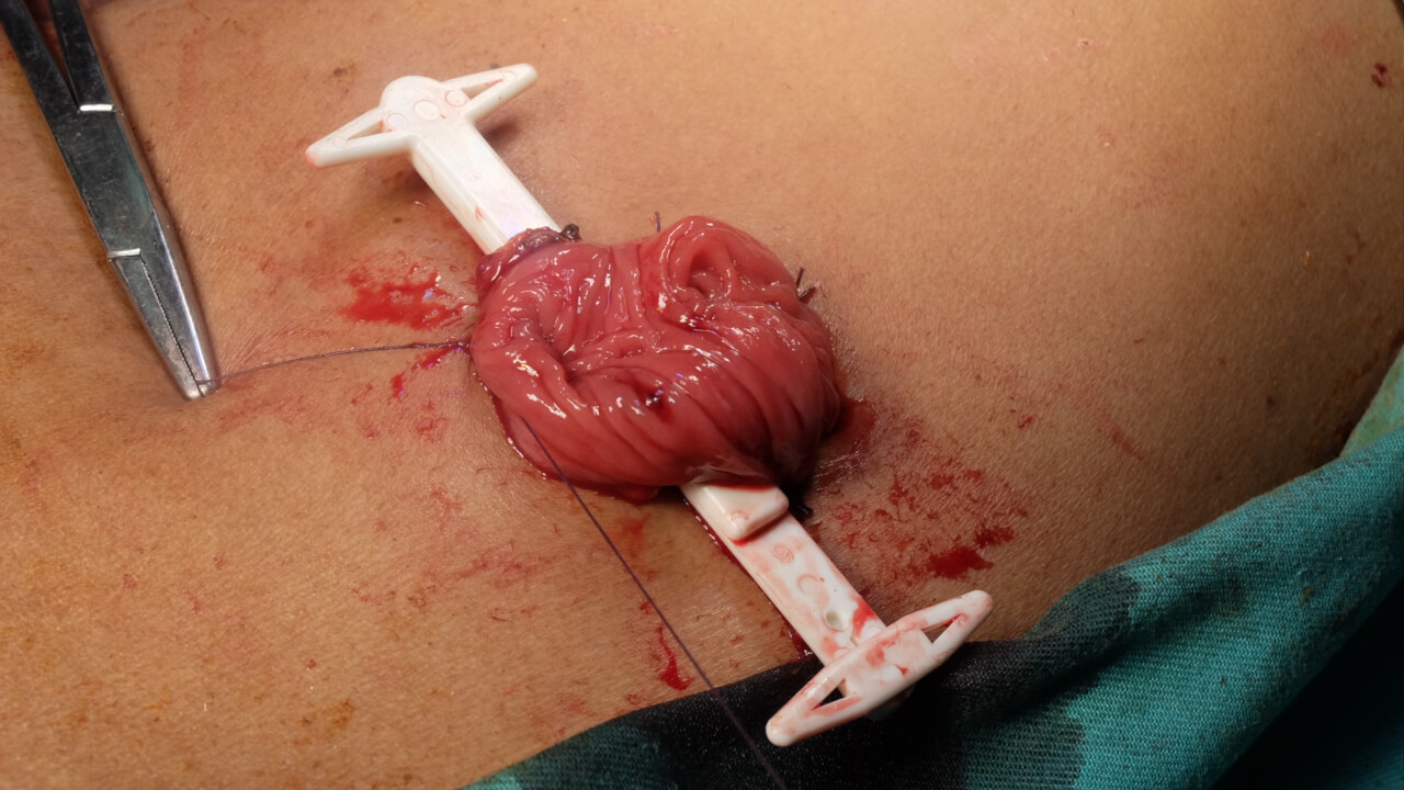 loop colostomy