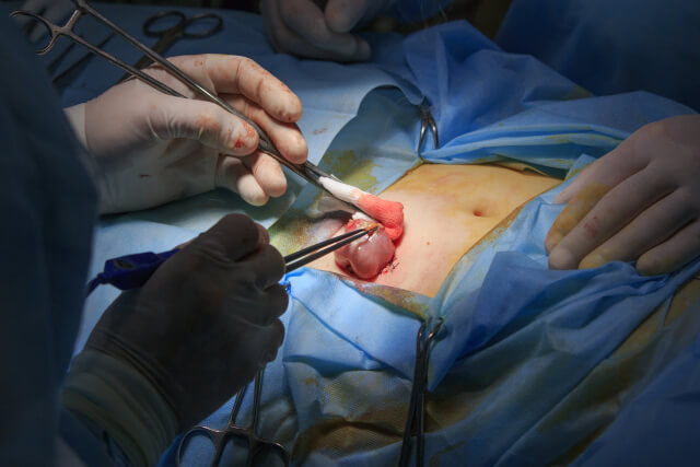 Overview about Loop Colostomy | Ostomy Association of Boston
