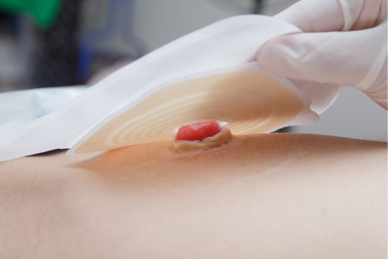 ostomy rehabilitation specialist