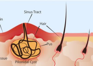 pilonidal sinus surgery