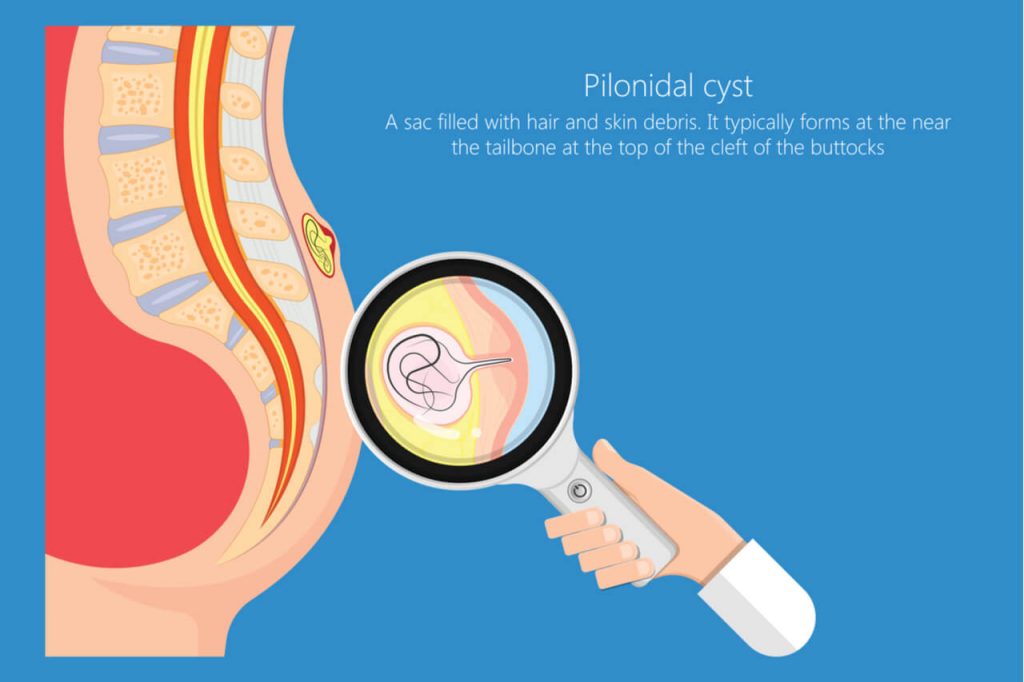 pilonidal sinus surgery