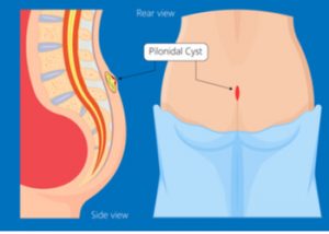 pilonidal sinus surgery