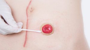 loop colostomy