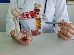 diffuse peritonitis sigmoid colon